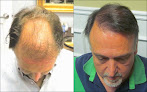 Your hair transplant and cost Hair Restoration Specialists in Sandy Springs in Georgia