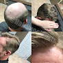 Your hair transplant and cost Hair Specialists Lincoln in Lincoln in Nebraska