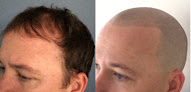 Your hair transplant and cost Hair Train Scalp Micropigmentation in Colorado Springs in Colorado