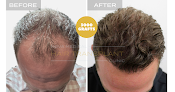 Your hair transplant and cost Hair Transplant Florida | Nova Medical in Miami in Florida