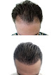 Your hair transplant and cost Hair Transplant Hawaii in Honolulu in Hawaii