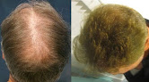 Your hair transplant and cost Hair Transplant Los Angeles Dr. Sean Behnam in Los Angeles in Los Angeles
