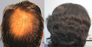 Your hair transplant and cost Hair Transplant Los Angeles Dr. Sean Behnam in Los Angeles in CA