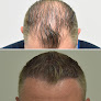 Your hair transplant and cost Hair Transplant Los Angeles - La Fue Hair Clinic - Los Angeles Fue Hair Transplant Clinic in Pasadena in Los Angeles