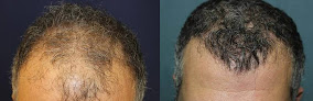 Your hair transplant and cost Hair Transplant Newport Beach: Dr. Richard Chaffoo, California Hair Md in Newport Beach in California