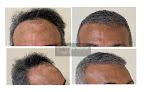 Your hair transplant and cost Hair Transplant Of Puerto Rico in San Juan in Puerto Rico