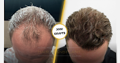 Your hair transplant and cost Hair Transplant Philadelphia | Nova Medical in Philadelphia in Pennsylvania