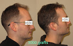 Your hair transplant and cost Hair Transplant & Restoration Center in Macon in Georgia