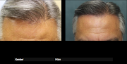 Your hair transplant and cost Hair Transplant San Diego: Dr. Richard Chaffoo, California Hair Md in San Diego in California
