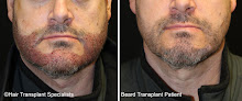Your hair transplant and cost Hair Transplant Specialists in Eagan in Minnesota