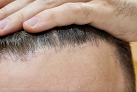 Your hair transplant and cost Hair Transplants Los Angeles in Redondo Beach in California