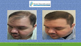 Your hair transplant and cost Hair Transplants Of Florida in Fort Myers in Florida