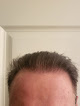 Your hair transplant and cost Hair Transplants Of Florida in Sarasota in Florida