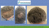 Your hair transplant and cost Hair Transplants Of Florida in Orlando in Florida