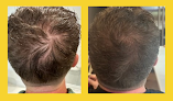 Your hair transplant and cost Hair Z System in Chicago in IL