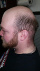 Your hair transplant and cost Hairbuilders in North Vassalboro in Maine