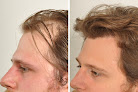 Your hair transplant and cost Haircaremd in New York in New York