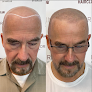 Your hair transplant and cost Hairclub in Albuquerque in New Mexico