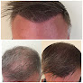 Your hair transplant and cost Hairline Studios in Orlando in Florida