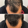 Your hair transplant and cost Havilah Hair Restoration in Peachtree City in Georgia
