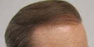 Your hair transplant and cost Holt Hair Restoration Center in Grand Rapids in Michigan