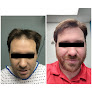 Your hair transplant and cost Honest Hair Restoration in Tampa in Florida