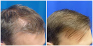 Your hair transplant and cost Houston Hair Transplant Center - Dr Goran Jezic in Houston in Texas