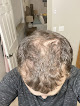 Your hair transplant and cost Hri Of Pennsylvania in Pittsburgh in Pennsylvania