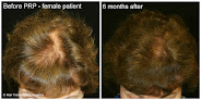 Your hair transplant and cost Ineedmorehair.com in Eagan in Minnesota