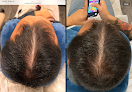 Your hair transplant and cost Integracare Medical Care And Aesthetics in Vineyard in Utah