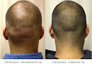 Your hair transplant and cost International Hair Surgical Group (Ihsg) in Edison in New Jersey