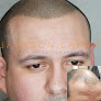 Your hair transplant and cost Jackson Lamar Scalp Micropigmentation in Dallas in Texas