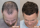Your hair transplant and cost Jae Pak, M.d. in Los Angeles in California