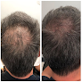 Your hair transplant and cost John Frank Md Hair Clinics in New York in New York