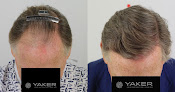 Your hair transplant and cost Joseph R. Yaker, Md - Yaker Hair Restoration + Med Spa in Plano in Texas