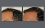 Your hair transplant and cost Kalos Hair Transplant Llc in Atlanta in Georgia