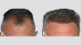 Your hair transplant and cost Kopelman Hair Restoration Nyc: Hair Transplant Clinic in New York in New York