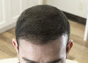 Your hair transplant and cost L.a. Hair Clinic in Torrance in California