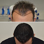 Your hair transplant and cost La Fue Hair New York in Garden City in New York