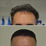 Your hair transplant and cost La Fue Hair New York in New York in New York