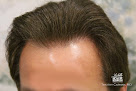 Your hair transplant and cost La Jolla Hair Restoration in La Jolla in California