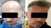 Your hair transplant and cost Las Vegas Hair Restoration in Las Vegas in Nevada