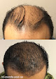 Your hair transplant and cost Le Aesthetic in Milpitas in California