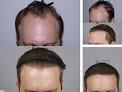 Your hair transplant and cost Linkov Hair Surgery in New York in New York