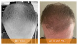 Your hair transplant and cost Louisville Hair Doctor in Louisville in KY