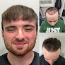 Your hair transplant and cost Mane Image Hair Replacement Center in Merrillville in IN