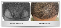 Your hair transplant and cost Maryland Hair Transplant in Glen Burnie in Maryland