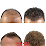 Your hair transplant and cost Maxim Hair Restoration & Transplants - Charlotte in Charlotte in North Carolina