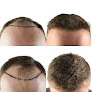 Your hair transplant and cost Maxim Hair Restoration & Transplants - San Antonio in San Antonio in Texas