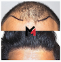 Your hair transplant and cost Maxim Hair Restoration & Transplants - Virginia in Alexandria in Virginia